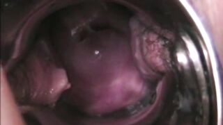 CERVIKAL CLIMAX IN DETAIL